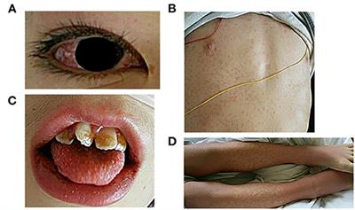 Case Report: Rehabilitation for Lower Extremity Pain Due to Venous Stasis in a Patient With Multisystem Inflammatory Syndrome in Children